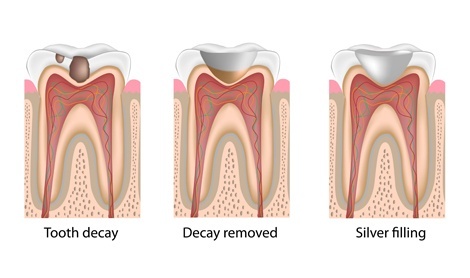 The three stages of a dental bonding procedure