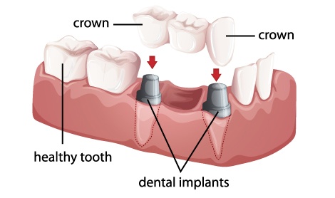 Graphic of a dental crown and bridges