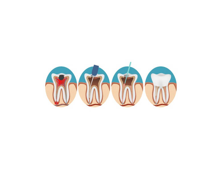 A graphic showing the process of root canal treatment