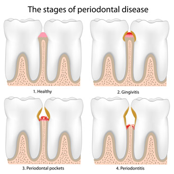 Graph of the four stages of periodontal disease