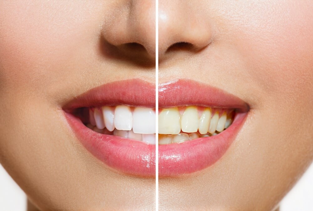 Should You Whiten Teeth At Home or In the Dentist’s Office?